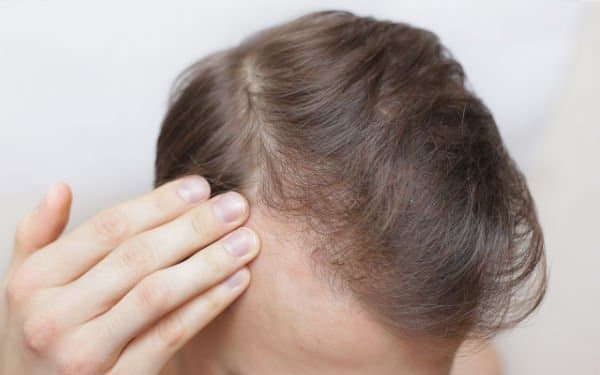 HAIR LOSS TREATMENT FOR MEN