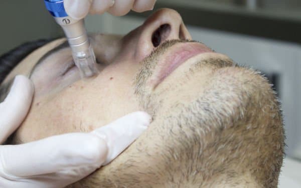 MICRONEEDLING MEN